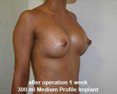plastic-surgery-breast-augmentation